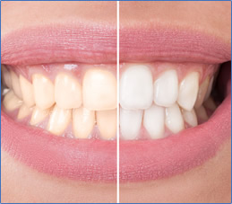 Tooth Whitening