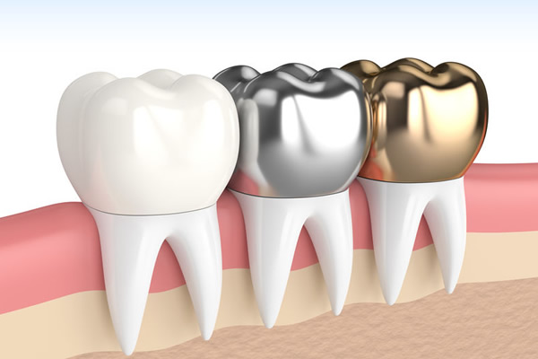 Ceramic Crowns